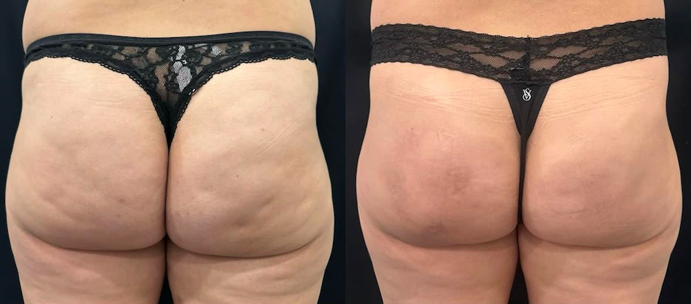 SOMA Cosmetic Surgery & Aesthetics result — Clive, IA