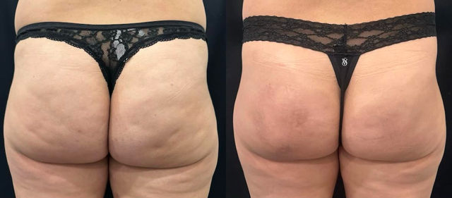 Brazilian Butt Lift result at SOMA Cosmetic Surgery & Aesthetics in Clive, IA
