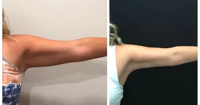 Brazilian Butt Lift result at SOMA Cosmetic Surgery & Aesthetics in Clive, IA