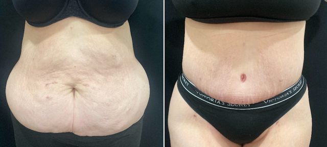 Tummy Tuck result at SOMA Cosmetic Surgery & Aesthetics in Clive, IA
