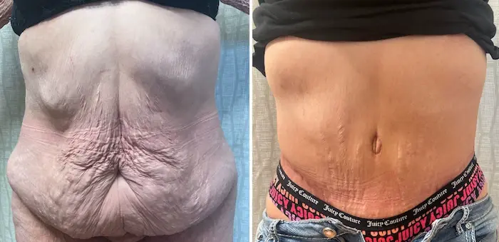 SOMA Cosmetic Surgery & Aesthetics tummy tuck result — Clive, IA