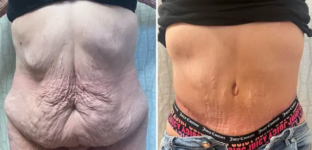 Tummy Tuck result at SOMA Cosmetic Surgery & Aesthetics in Clive, IA