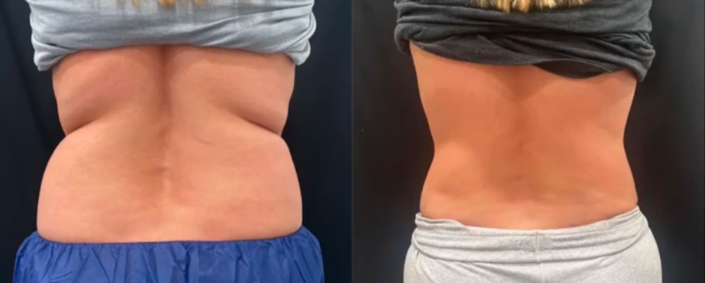 SOMA Cosmetic Surgery & Aesthetics result — Clive, IA