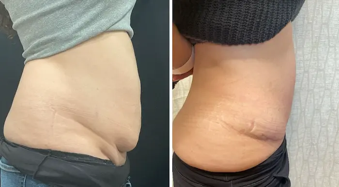 SOMA Cosmetic Surgery & Aesthetics tummy tuck result — Clive, IA