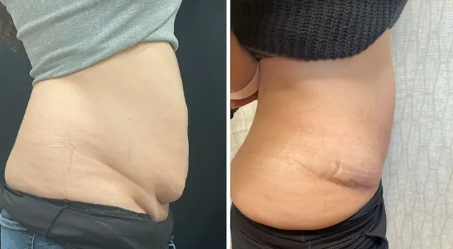 Tummy Tuck result at SOMA Cosmetic Surgery & Aesthetics in Clive, IA
