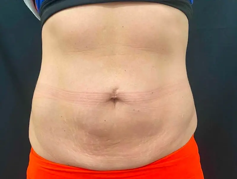 SOMA Cosmetic Surgery & Aesthetics liposuction after — Clive, IA