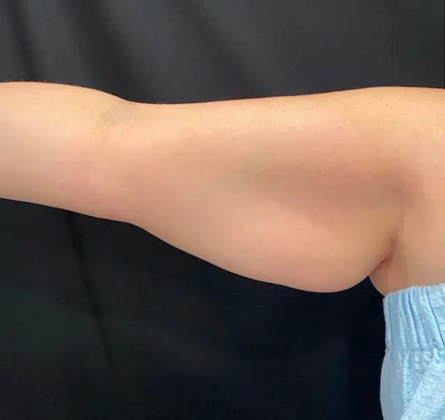 Brazilian Butt Lift before at SOMA Cosmetic Surgery & Aesthetics in Clive, IA