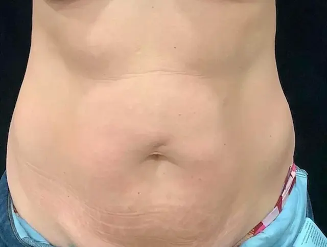Brazilian Butt Lift before at SOMA Cosmetic Surgery & Aesthetics in Clive, IA