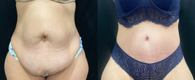 Tummy Tuck result at SOMA Cosmetic Surgery & Aesthetics in Clive, IA