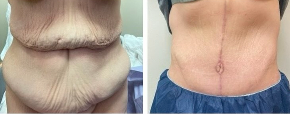 SOMA Cosmetic Surgery & Aesthetics tummy tuck result — Clive, IA