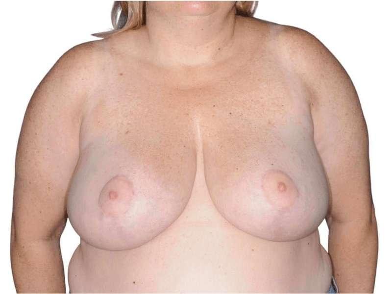 Jay Shenaq, MD breast reduction after — Sugar Land, TX