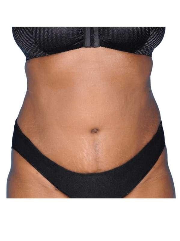 Jay Shenaq, MD tummy tuck after — Sugar Land, TX