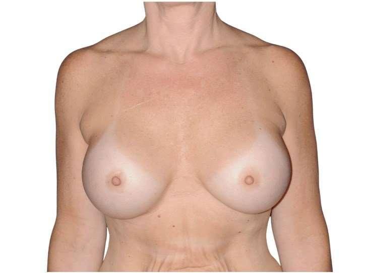 Jay Shenaq, MD breast augmentation after — Sugar Land, TX