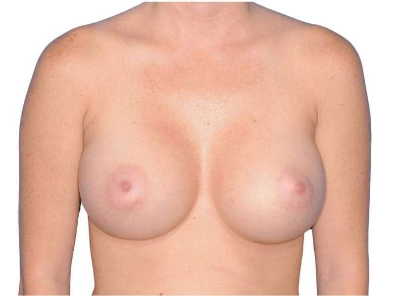 Jay Shenaq, MD breast augmentation after — Sugar Land, TX