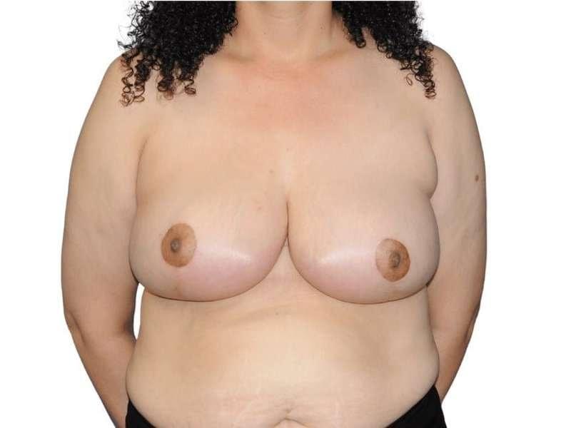 Jay Shenaq, MD breast reduction after — Sugar Land, TX