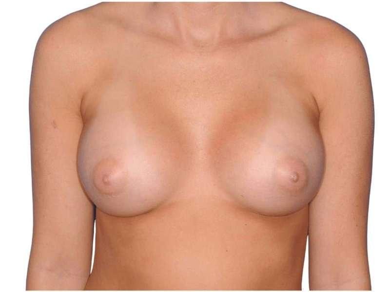 Jay Shenaq, MD breast augmentation after — Sugar Land, TX