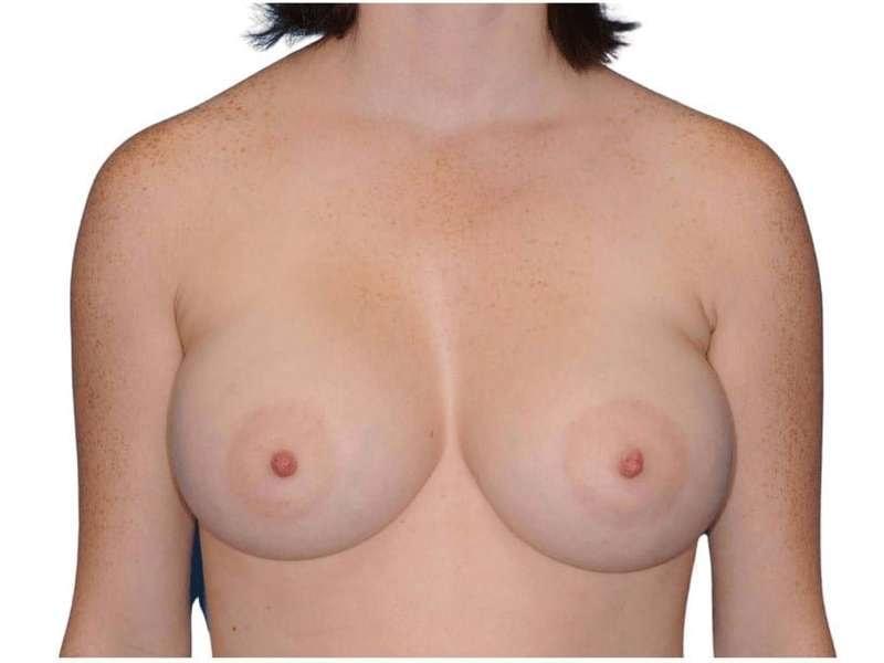 Jay Shenaq, MD breast augmentation after — Sugar Land, TX