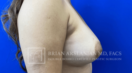 Arslanian Plastic Surgery: Dr. Brian Arslanian body contouring result — Brookhaven, GA