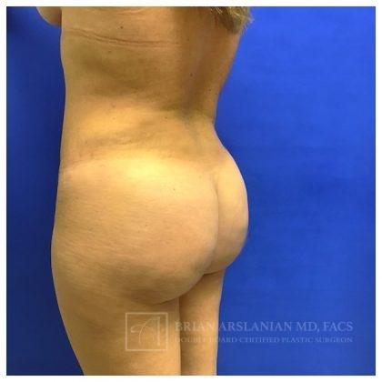 Arslanian Plastic Surgery: Dr. Brian Arslanian body contouring after — Brookhaven, GA