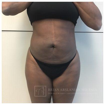 Arslanian Plastic Surgery: Dr. Brian Arslanian body contouring after — Brookhaven, GA