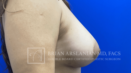Arslanian Plastic Surgery: Dr. Brian Arslanian body contouring result — Brookhaven, GA