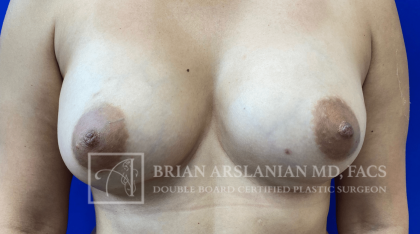 Arslanian Plastic Surgery: Dr. Brian Arslanian body contouring result — Brookhaven, GA