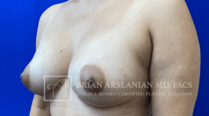 Arslanian Plastic Surgery: Dr. Brian Arslanian body contouring result — Brookhaven, GA