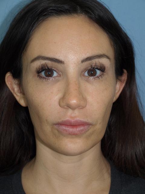 Brow Lift after at Bao Phan MD - Hawaii Plastic Surgery Institute in Honolulu, HI