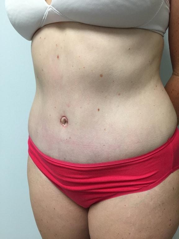 Mini Tummy Tuck after at Bao Phan MD - Hawaii Plastic Surgery Institute in Honolulu, HI