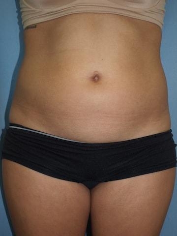 Liposuction before at Bao Phan MD - Hawaii Plastic Surgery Institute in Honolulu, HI