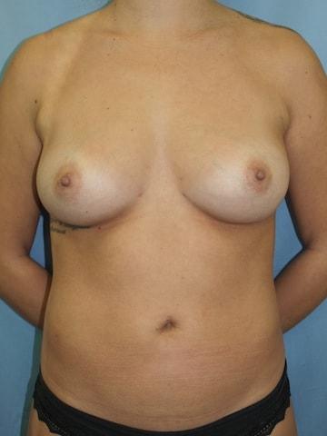 Liposuction after at Bao Phan MD - Hawaii Plastic Surgery Institute in Honolulu, HI