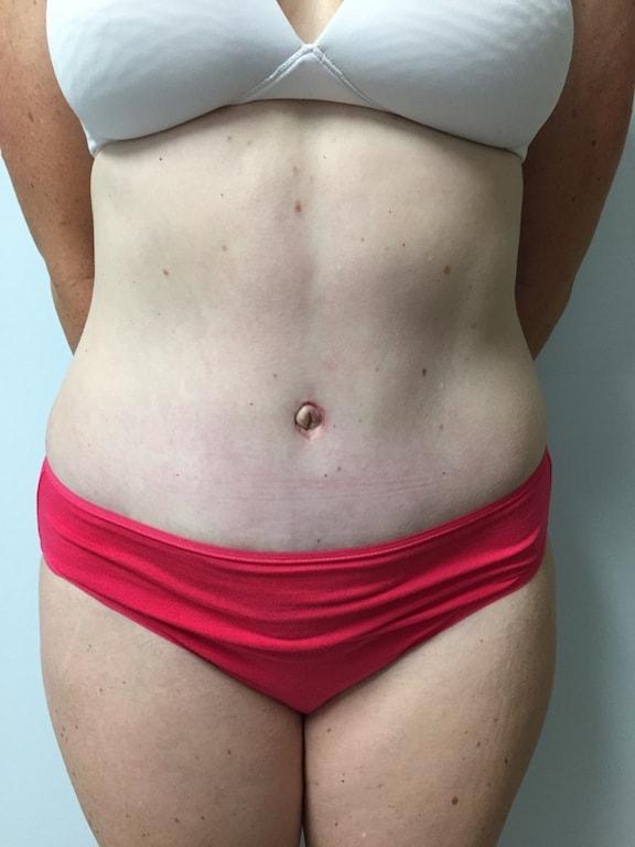 Mini Tummy Tuck after at Bao Phan MD - Hawaii Plastic Surgery Institute in Honolulu, HI