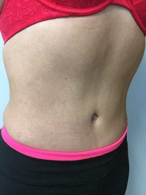 Mini Tummy Tuck after at Bao Phan MD - Hawaii Plastic Surgery Institute in Honolulu, HI