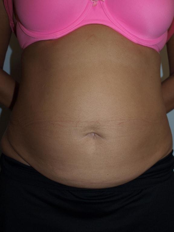 Mini Tummy Tuck before at Bao Phan MD - Hawaii Plastic Surgery Institute in Honolulu, HI