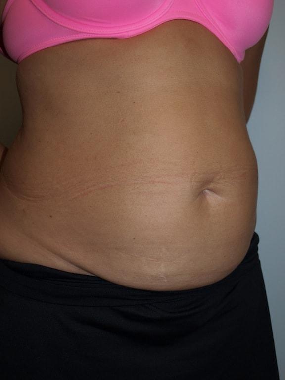 Mini Tummy Tuck before at Bao Phan MD - Hawaii Plastic Surgery Institute in Honolulu, HI