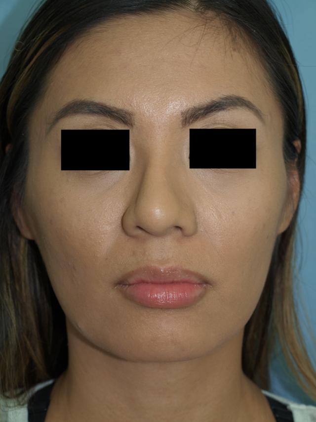 Rhinoplasty before at Bao Phan MD - Hawaii Plastic Surgery Institute in Honolulu, HI
