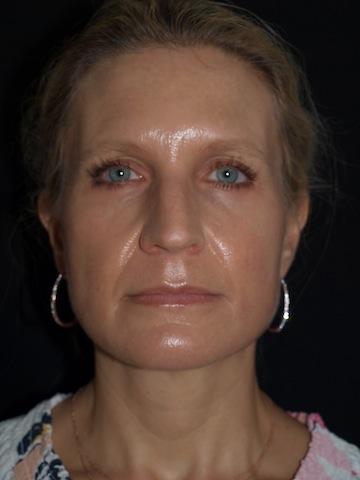 Brow Lift before at Bao Phan MD - Hawaii Plastic Surgery Institute in Honolulu, HI