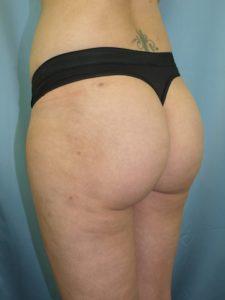 Brazilian Butt Lift after at Bao Phan MD - Hawaii Plastic Surgery Institute in Honolulu, HI