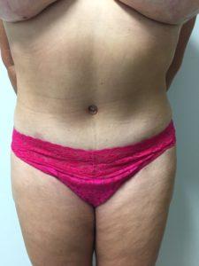 Mini Tummy Tuck after at Bao Phan MD - Hawaii Plastic Surgery Institute in Honolulu, HI