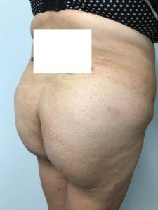 Bao Phan MD - Hawaii Plastic Surgery Institute bbl after — Honolulu, HI