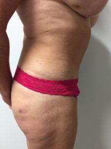 Bao Phan MD - Hawaii Plastic Surgery Institute tummy tuck after — Honolulu, HI