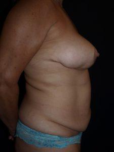 Mini Tummy Tuck before at Bao Phan MD - Hawaii Plastic Surgery Institute in Honolulu, HI