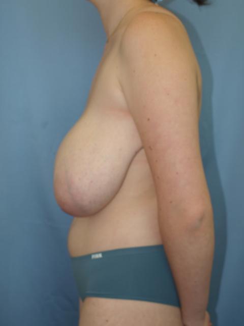 Breast Reduction before at Bao Phan MD - Hawaii Plastic Surgery Institute in Honolulu, HI