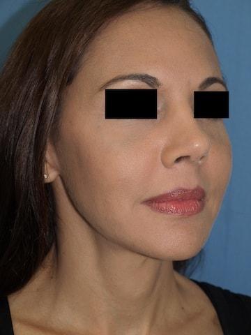 Rhinoplasty after at Bao Phan MD - Hawaii Plastic Surgery Institute in Honolulu, HI