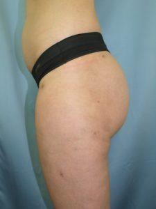 Bao Phan MD - Hawaii Plastic Surgery Institute bbl after — Honolulu, HI