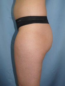 Brazilian Butt Lift before at Bao Phan MD - Hawaii Plastic Surgery Institute in Honolulu, HI