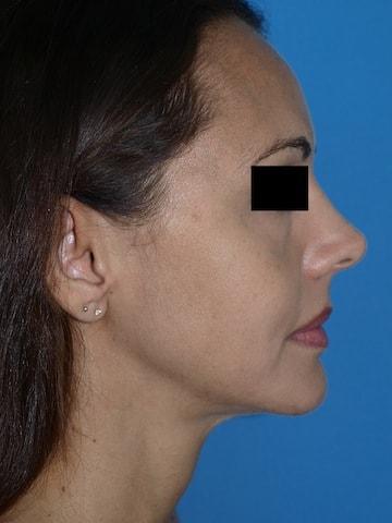 Rhinoplasty before at Bao Phan MD - Hawaii Plastic Surgery Institute in Honolulu, HI