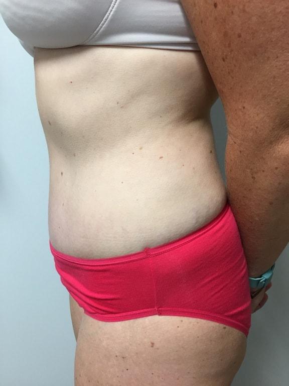 Bao Phan MD - Hawaii Plastic Surgery Institute tummy tuck after — Honolulu, HI