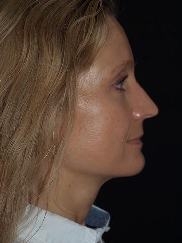 Brow Lift after at Bao Phan MD - Hawaii Plastic Surgery Institute in Honolulu, HI