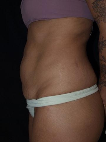 Mini Tummy Tuck before at Bao Phan MD - Hawaii Plastic Surgery Institute in Honolulu, HI